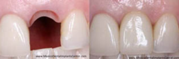 Dental Implants Patient Single tooth replacement