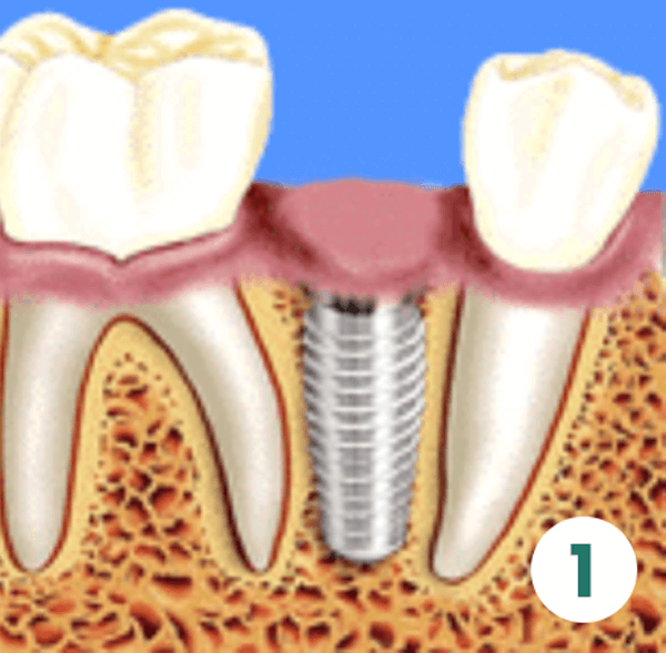 Prosthetic Phase (Teeth)