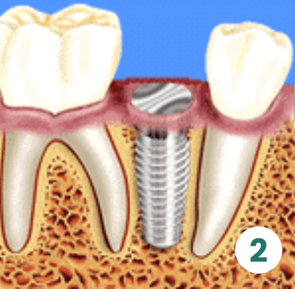 First Surgical Phase (Implant Placement)