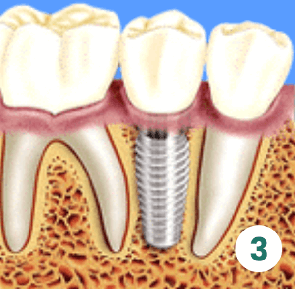 Second Surgical Phase (Implants Uncovery)