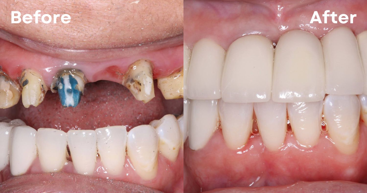 All-on-4 Dental Implants in Tijuana (Near San Diego): A 2026 Patient Guide